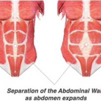 Rectis Diastasis